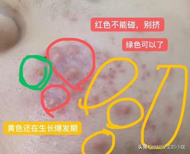 长痘并不可怕拯救痘痘肌,长痘痘了不要怕教你轻松一招解决