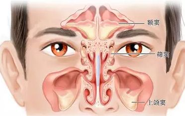 鼻窦炎久治难愈,鼻窦炎用药一直不得好转怎么办