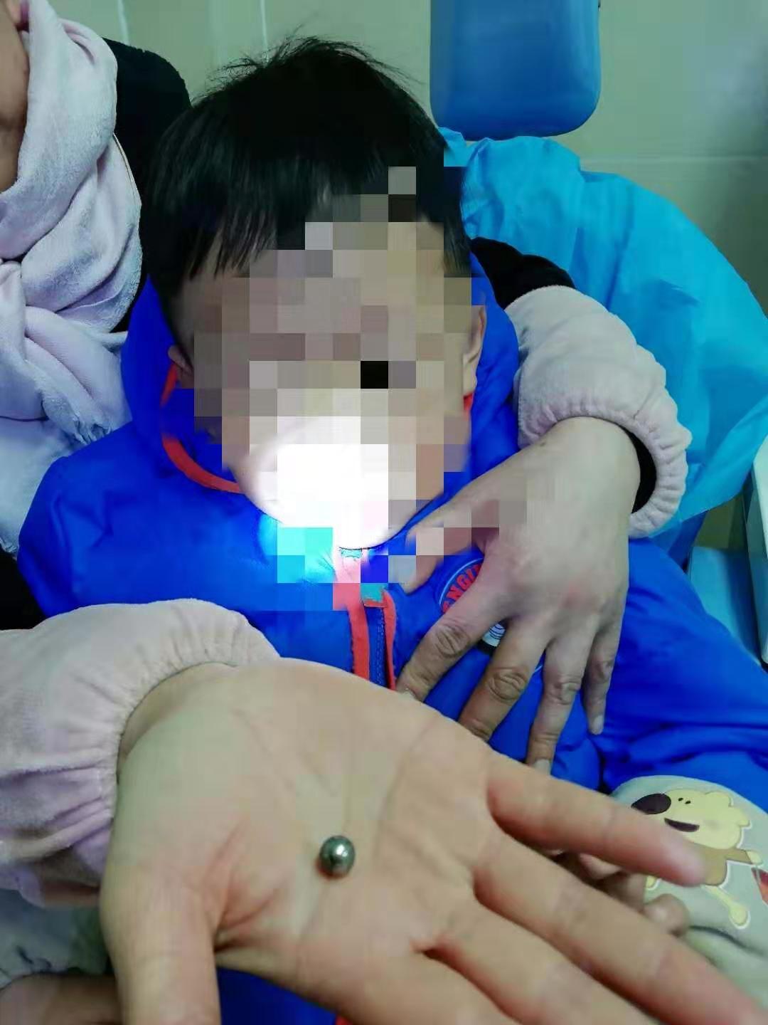 家长注意！徐州多名孩子鼻孔里出现了*珠钢**、西瓜、橡皮泥……