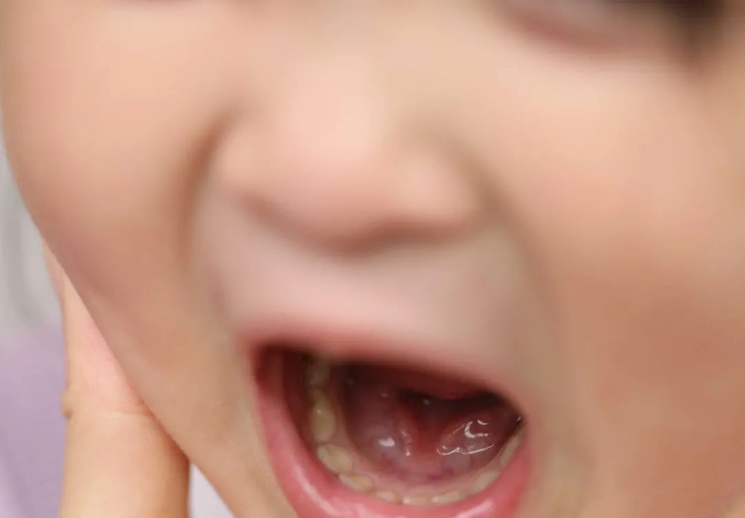 关于孩子长蛀牙的知识误区,3岁孩子牙齿全坏了怎么办