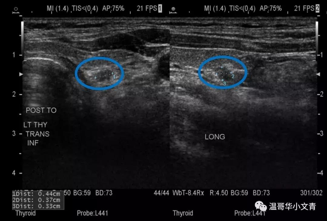 甲状腺癌治疗最好的医院排名,中药治疗甲状腺癌的有效方法