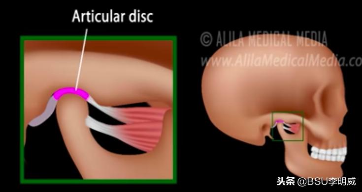 牙咬肌疼的张不开嘴怎么缓解,牙痛咬肌酸痛怎么回事