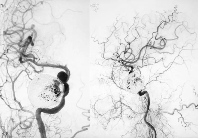 国外怎么治疗动脉瘤,全世界颅内动脉瘤最佳的治疗