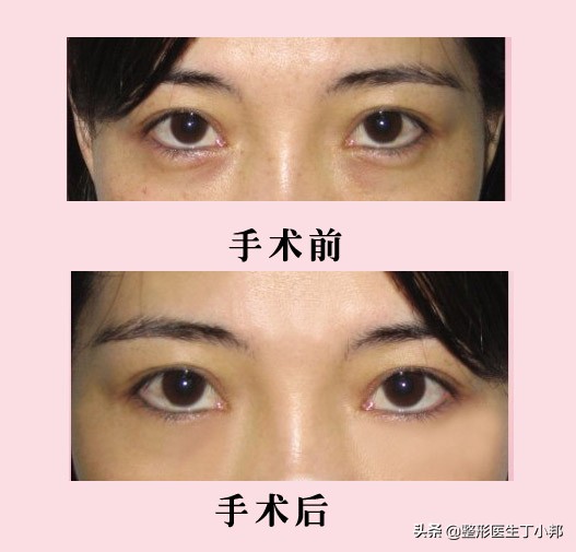 卧蚕怎么变成黑眼袋了图片,卧蚕怎么就成了眼袋