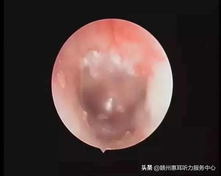 耳硬化症通过什么检查,耳硬化症的诊疗计划