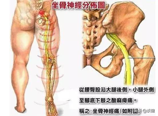 坐骨神经疼痛吃药不见轻,坐骨神经痛中医也治不好吗