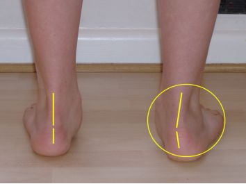 跑步足底痛的防治,足底跑步疼是什么症状