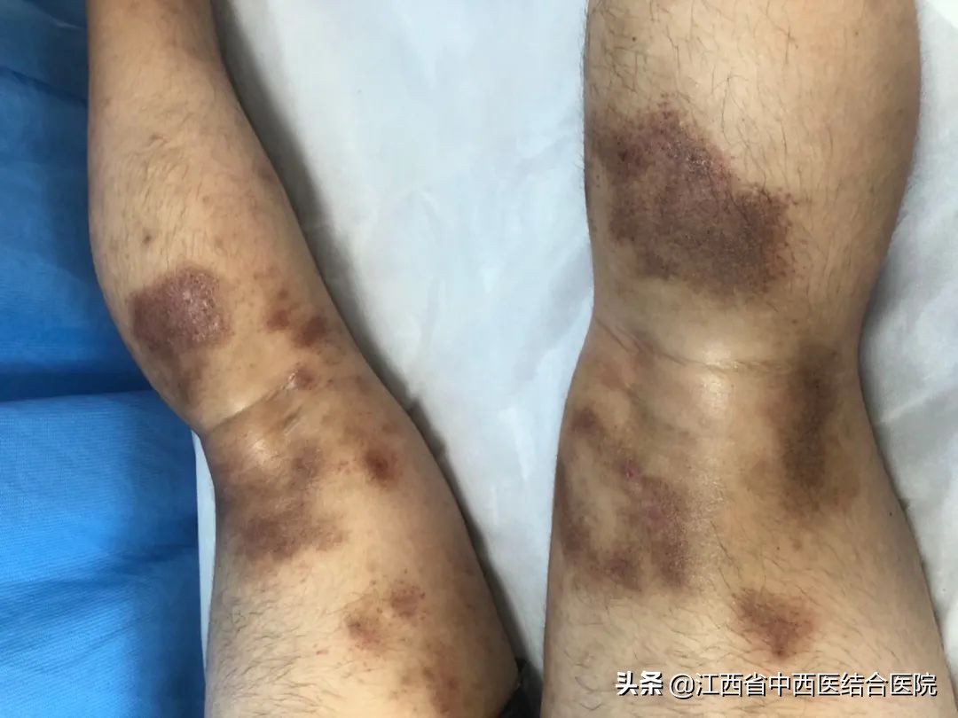 省级四弯风病重点研究室落户江西省中西医结合医院