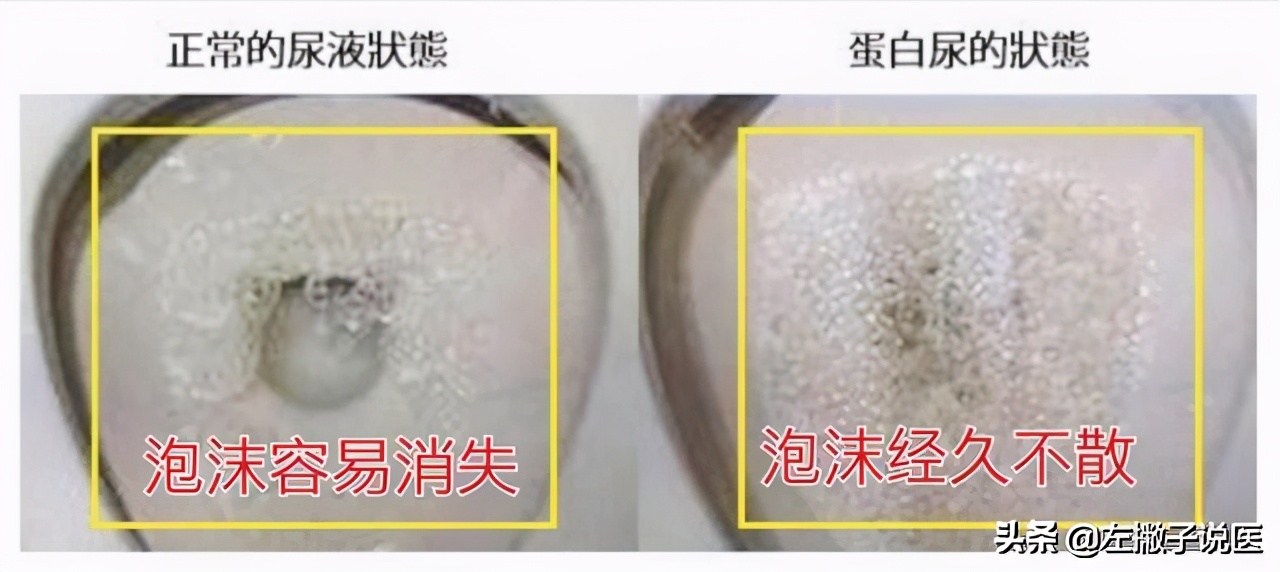 辟谣：尿液出现泡沫就是蛋白尿？一文跟你说清引起泡沫尿的原因