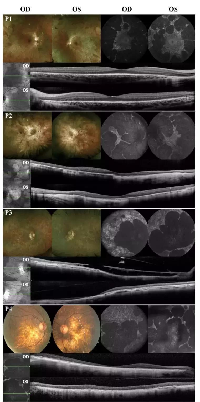 无脉络膜患者,无脉络膜症是怎样致盲