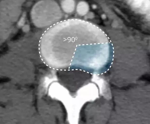 腰椎间盘的膨出和突出有什么区别,腰椎间盘膨出和突出有什么区别