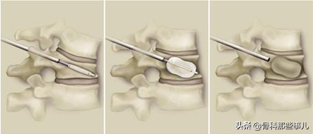 老人摔小腿骨折要手术吗,老年人腰椎压缩性骨折需住院多久