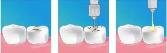 为什么现在的小孩子容易长蛀牙,经常吃糖的小孩蛀牙会成什么样