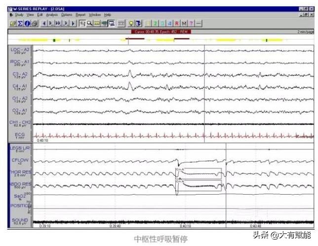 睡眠呼吸暂停监测全过程视频,深度解析呼吸暂停