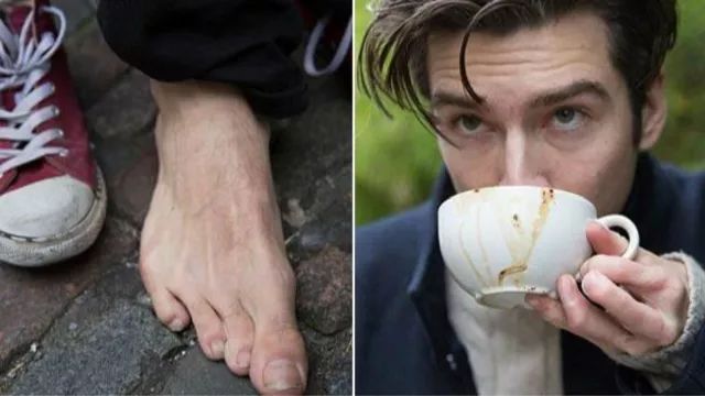 外国帅哥患波兰综合症，移植脚趾到手上，网友表示：看脸就行！