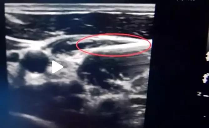 一针治百种病症 (一针治100种病症)