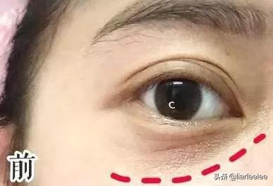 防眼角皱纹最好的方法,眼部皱纹多特别显老