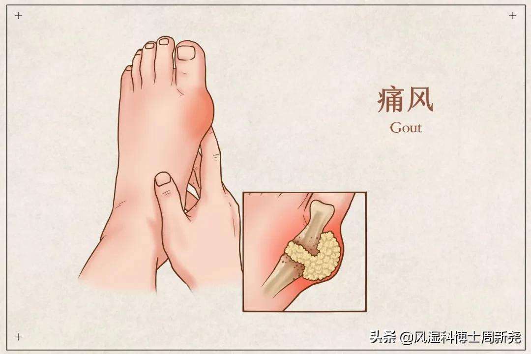 痛风要远离这四种不良习惯,为什么痛风病人最近犯得特别多