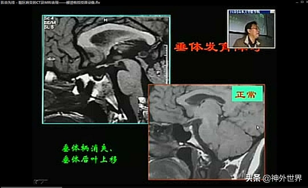 鞍区核磁解剖图,鞍区解剖与手术