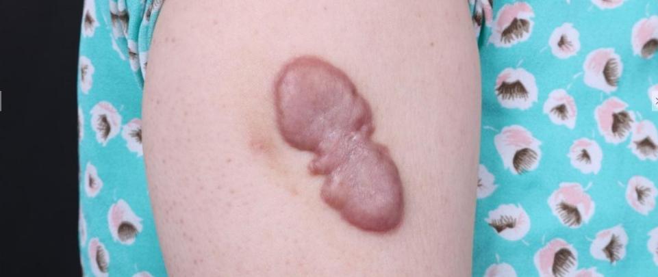 疤痕疙瘩可以去除吗？如何去除？