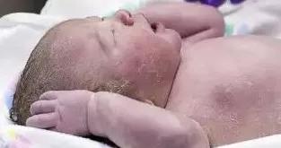 马牙宝宝有什么表现,马牙婴儿怎么治疗