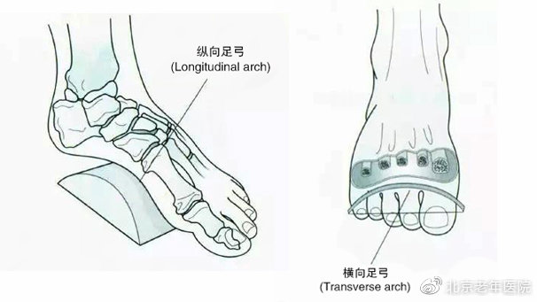 【为了您的健康，我们的专家有话说】足跟痛的黑锅不能全让骨刺来背，揪出幕后的真正元凶