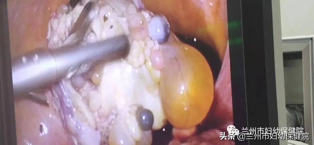 高龄盆腔肿瘤建议切除吗,腹腔镜手术卵巢肿瘤10cm