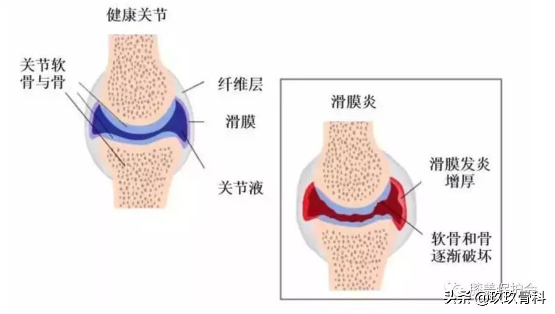 膝盖肿胀疼痛,滑膜炎找上门,要如何应对?