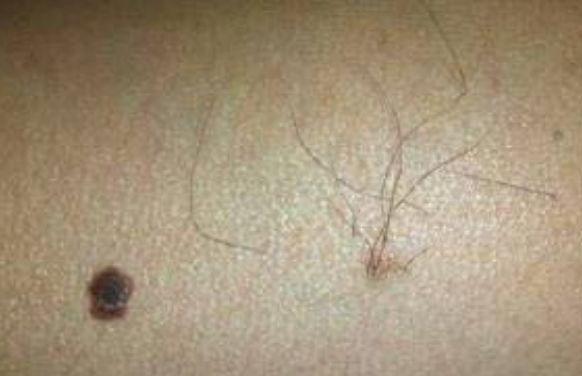 下巴黑痣上长毛预示什么,痣上长毛可以剪掉么