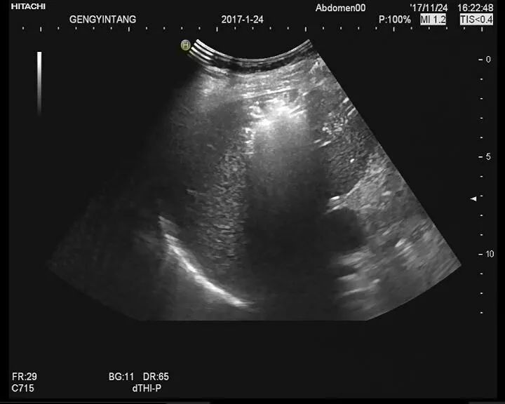 急性嗜酸性粒细胞性肺炎病理,嗜酸性粒细胞性肺炎病因