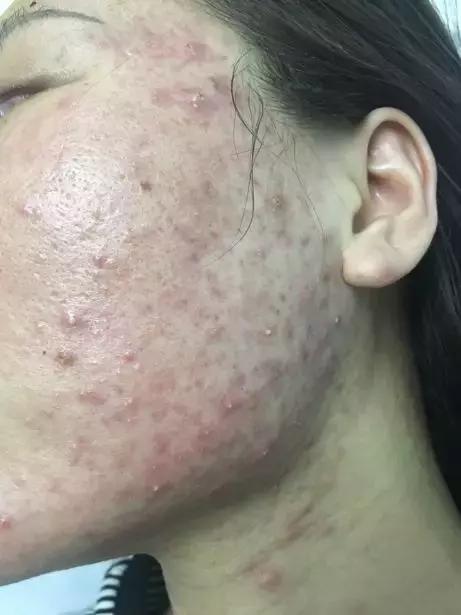 「许师解疑」难治性*疮痤**案析酸寒法