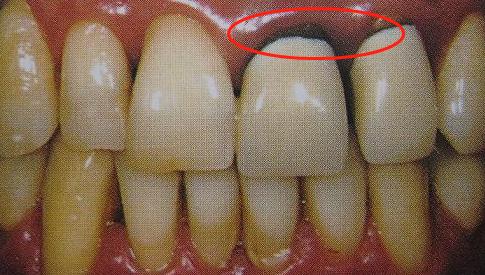 做烤瓷牙的利弊与危害,烤瓷牙失败的原因及解决方法