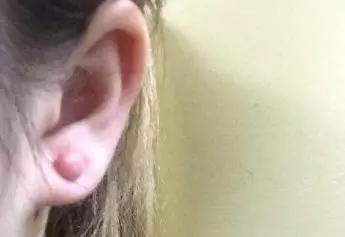 欣奕除疤凝胶对疤痕体质有效果吗,疤痕形成后用芦荟能除疤吗