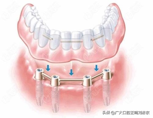 半口牙种牙全过程,半口缺牙怎么办种牙不花冤枉钱