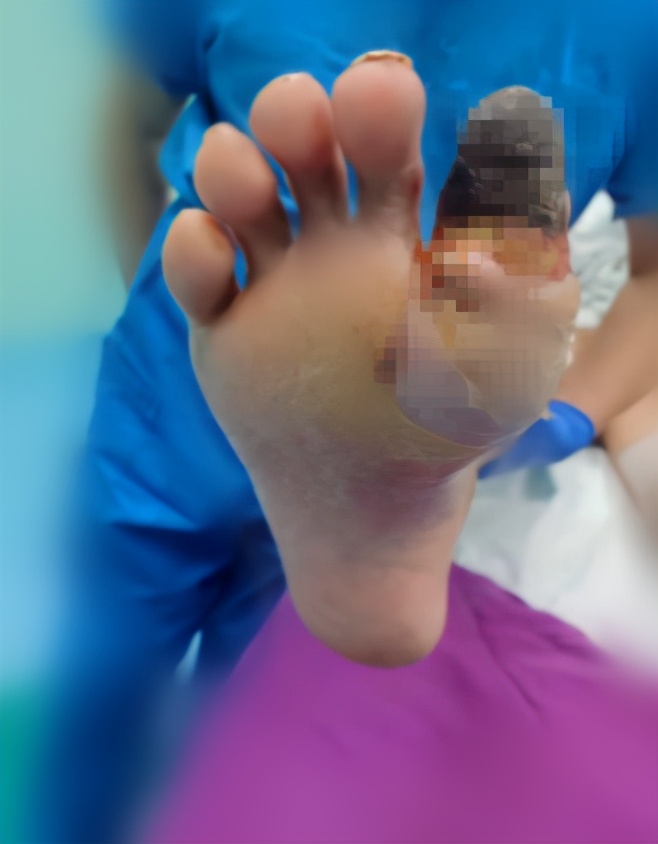 糖尿病脚趾溃烂病程进展,糖尿病脚趾溃烂长肉芽了多久好