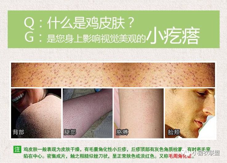 毛囊根部有凸起像鸡皮疙瘩痒,大腿毛囊有粉刺一样的疙瘩