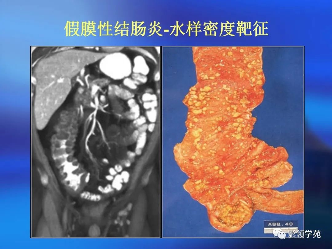 肠道内壁增厚,肠道扩张ct表现