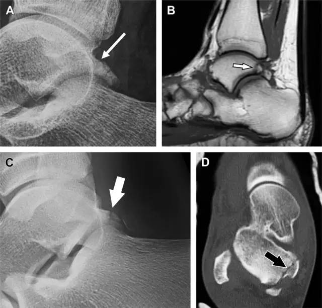 常见的八种骨折,容易漏诊的肩关节骨折