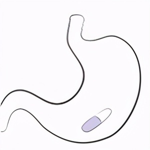 艾司奥美拉唑正确吃法,艾司奥美拉唑注射剂指南用法