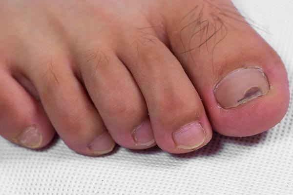 脚指甲旁边肉一碰就疼怎么办,为什么脚趾甲会长到肉里