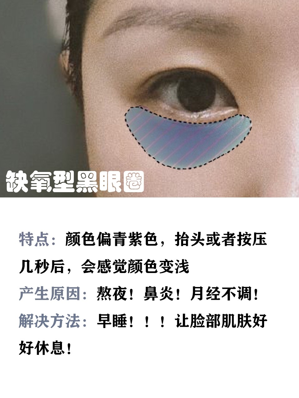 常年黑眼圈护肤品没效果,护肤品去黑眼圈用哪种