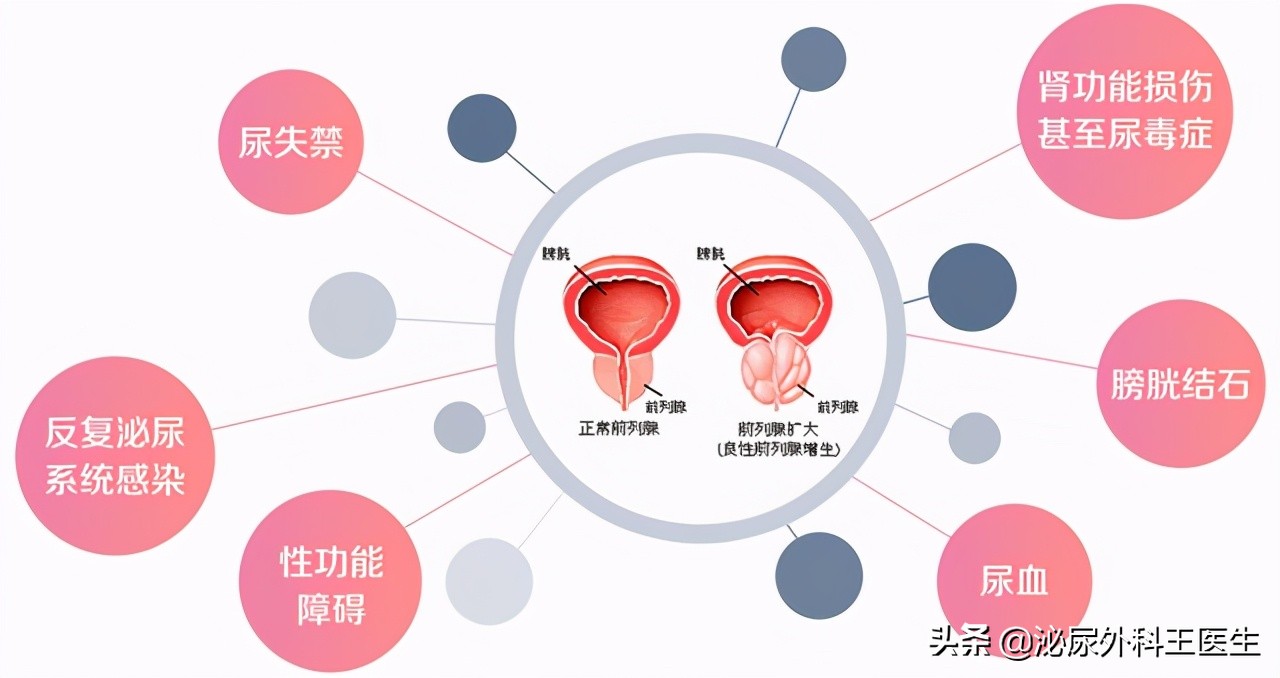 坦索罗辛缓解前列腺增生的机制,坦索罗辛治疗前列腺增生有效吗