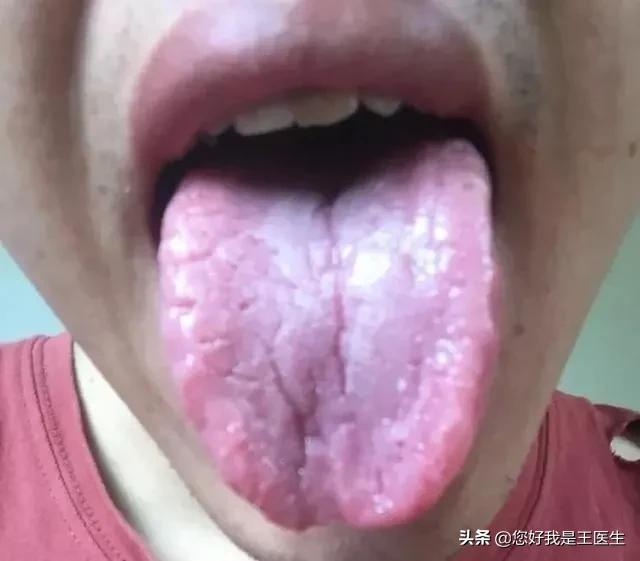 舌边有齿痕舌中有裂纹脾虚怎么办,舌边有齿痕中间有裂纹是什么原因