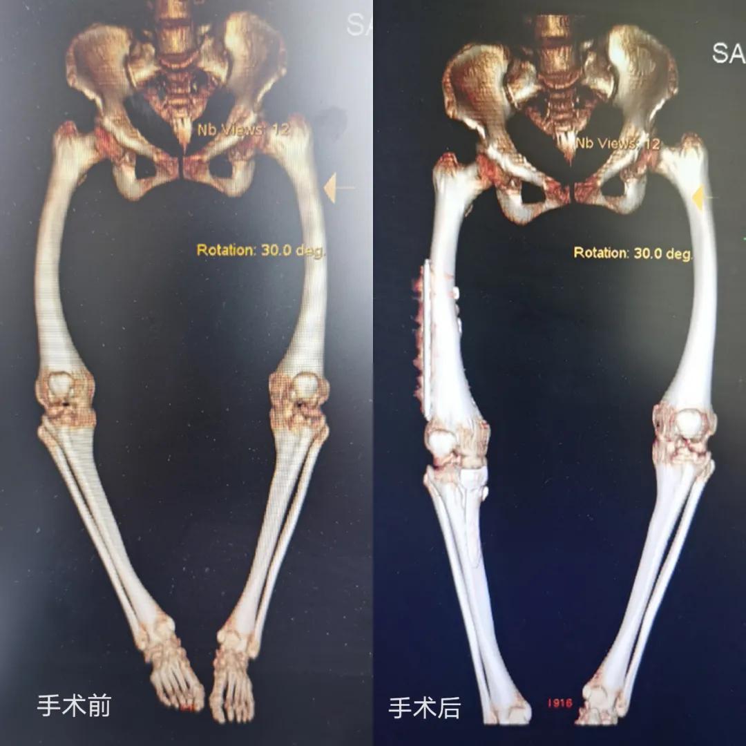 一场截肢手术,一场九死一生的手术