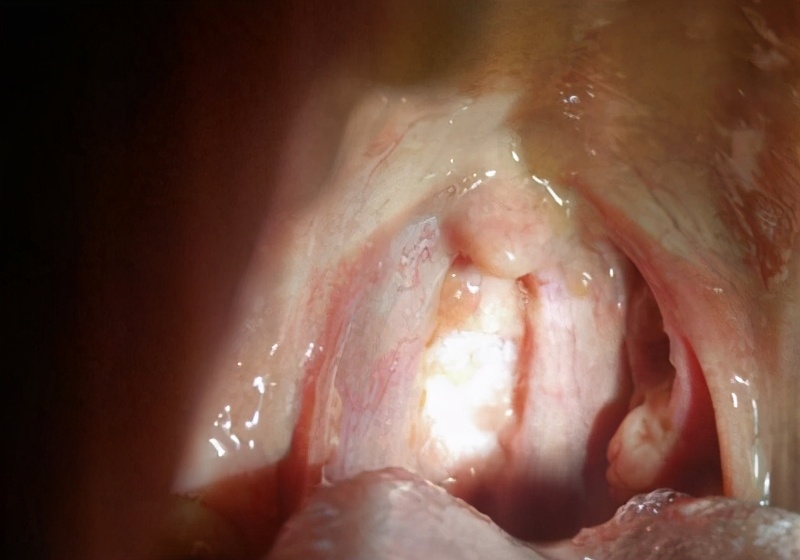 痛心！一男子声带癌前病变，只因常做这两件事