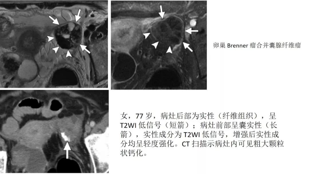 卵巢原发肿瘤的分析思路