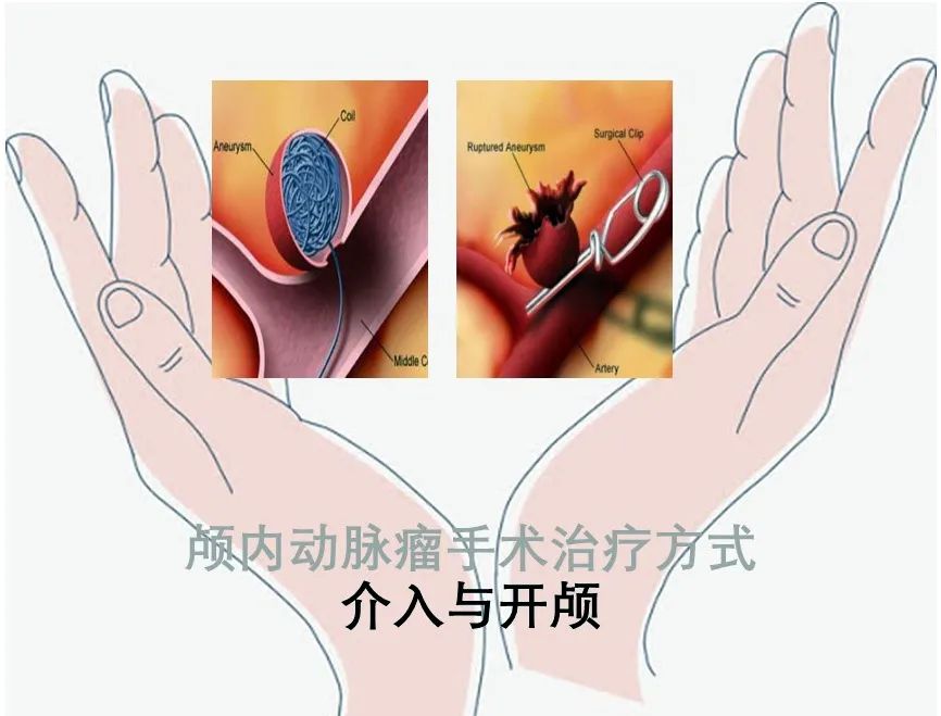 301医院颅内动脉瘤介入手术,颅内动脉瘤介入手术成功率