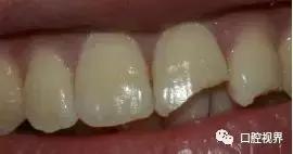 门牙撞了怎么办,门牙意外损坏怎么办