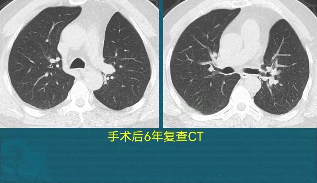 年纪大了得了肺癌怎么办,年纪轻轻得了肺癌怎么办