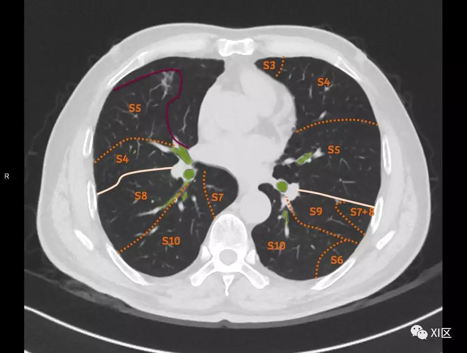 如此详细的肺部影像解剖，有点儿酷